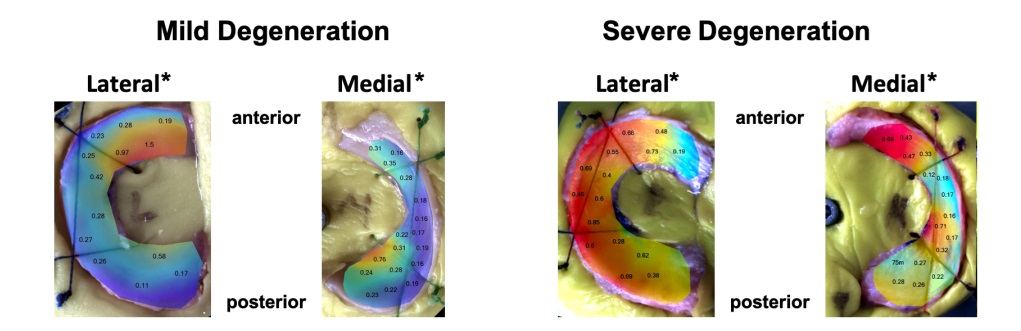 Cartilage mapping. From Seitz AM, Osthaus F, Schwer J, et al. Osteoarthritis-Related Degeneration Alters the Biomechanical Properties of Human Menisci Before the Articular Cartilage. Front Bioeng Biotechnol. 2021;9:659989. Published 2021 May 6. doi:10.3389/fbioe.2021.659989